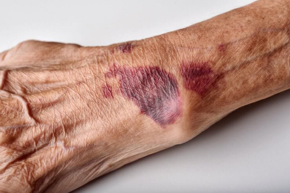 Close-up of an elderly person’s forearm showing large, dark purple bruises and thin, wrinkled skin. - Home Instead
